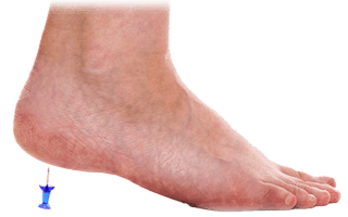 Hälsporrebehandlingar